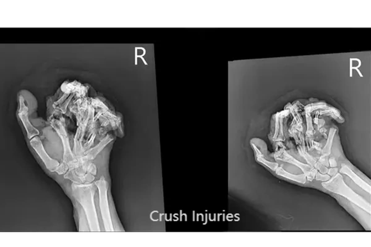 Press Brake Accidents